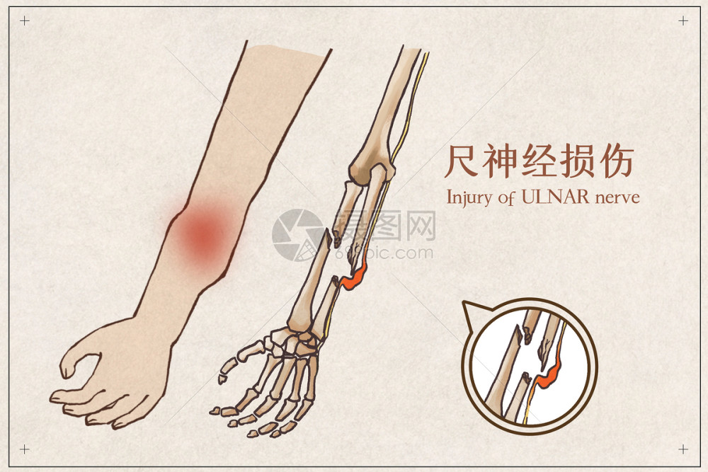 尺神经损伤示意图插画图片下载-正版图片401795606-摄图网