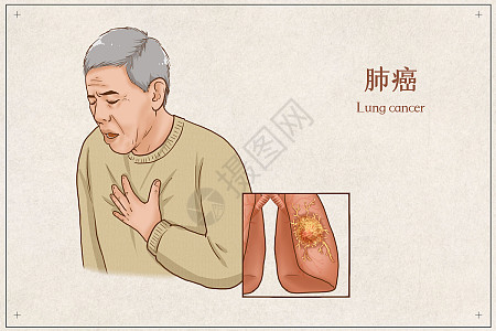 肺癌图片_肺癌素材_肺癌高清图片_摄图网图片下载