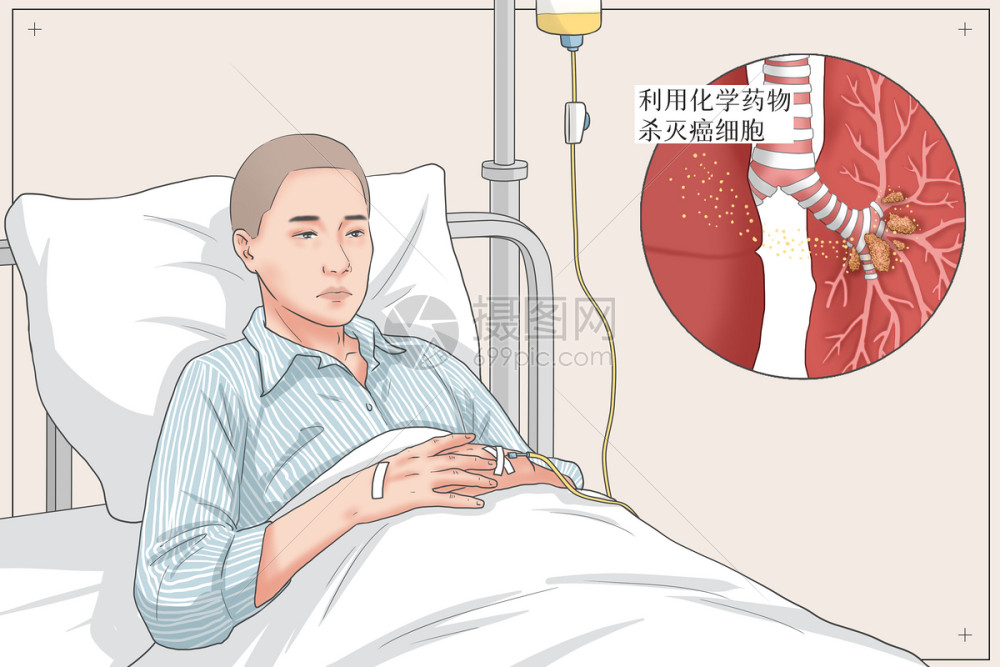肺癌化学治疗医疗插画插画图片下载-正版图片401803185-摄图网